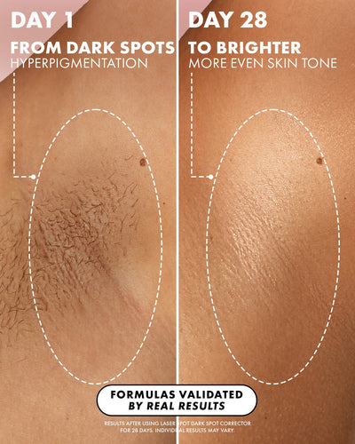 Laser Spot Dark Spot Treatment