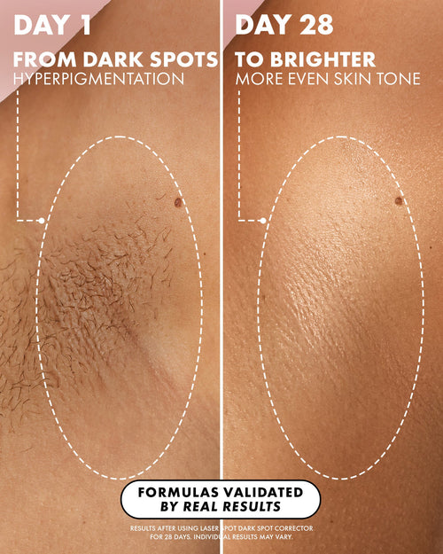 Laser Spot Dark Spot Treatment