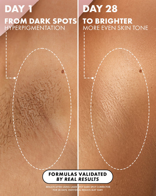 Laser Spot Dark Spot Treatment